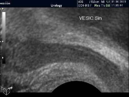Нормальные СП (ТР УЗИ)