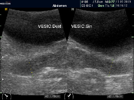 "Нормальные" СП (ТА УЗИ)