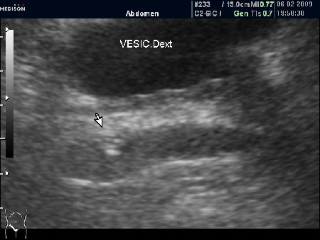 Небольшой участок фиброза в СП