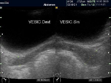 Асимметрия СП (ТА УЗИ)