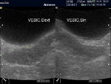Асимметрия СП (ТА УЗИ)