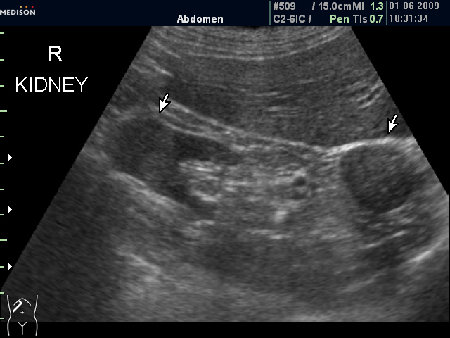 Правая почка
