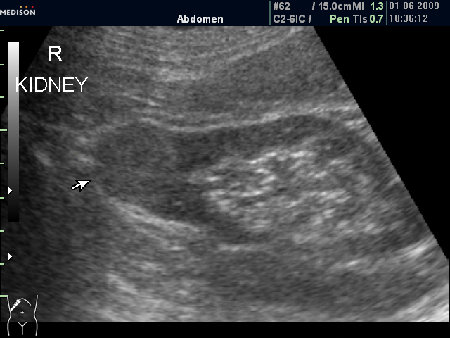 Образование в нижнем полюсе почки