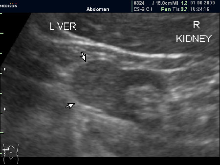 Образование в нижнем полюсе почки
