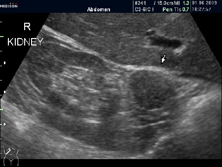 Образование у верхнего полюса почки