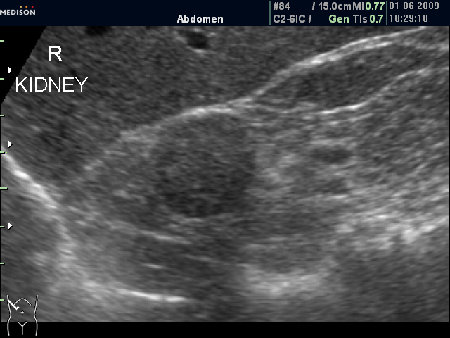 Образование у верхнего полюса почки