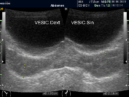 Утолщенные "рыхловатые" немного асимметричные СП (ТА УЗИ)