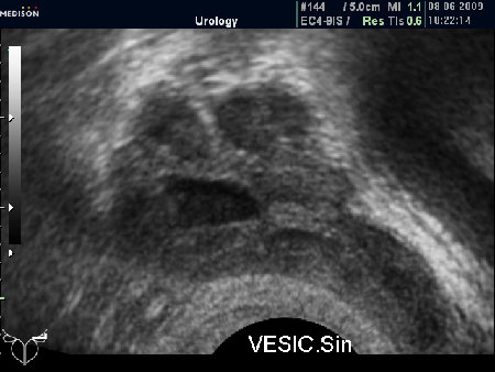 ТРУЗИ левого СП