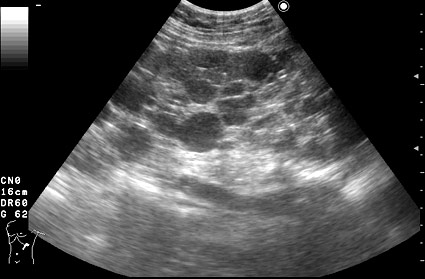 Тот же случай, сонограмма левой почки.