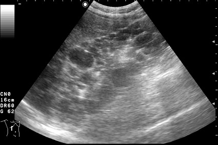 АДПКБП, сонограмма правой почки женщины 37 лет. Почка увеличена, паренхима замещена кистами различных размеров.