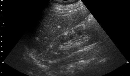 Сонограмма правой почки, продольное сканирование