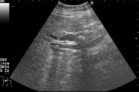 AAEE.jpg (30.97 КБ) 2025 просмотров Продольный скан холедоха
