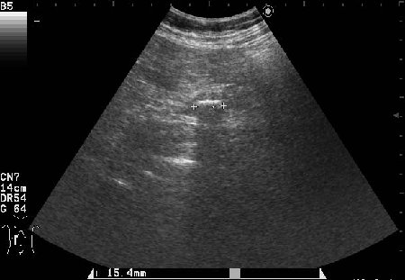 AAEC.jpg (27.61 КБ) 2026 просмотров Поперечный скан холедоха