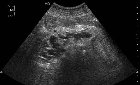 Продольная сонограмма панкреас