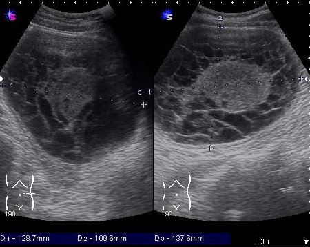 б\б и м\э консист., как говорится.   Исходит из н\ полюса левой почки