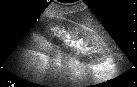 Продольное сканирование  правой почки. Почка 140х65х65 мм.