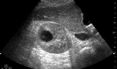 Поперечное сканирование правой почки на уровне верхней трети.